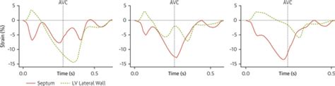 Mechanism Of Abnormal Septal Motion In Left Bundle Branch Block Role