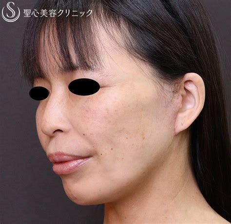 【40代女性・顔のボリューム、たるみ】フェイスリフト 脂肪吸引 頬 （2ヶ月後） 症例写真 美容整形、美容外科なら聖心美容クリニック