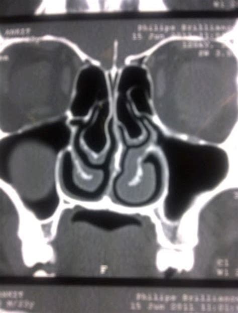 ENT Surgeon's blog: Concha Bullosa