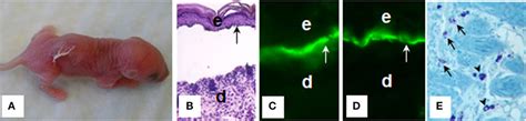 Frontiers The Autoimmune Skin Disease Bullous Pemphigoid The Role Of