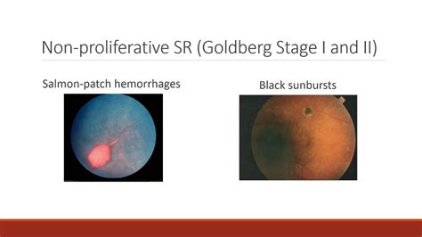 Sickle Cell Retinopathy | oneSCDvoice