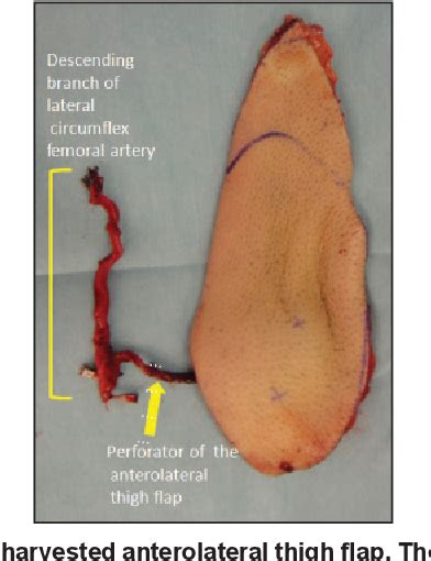 Figure 3 From Emergent Free Flow Through Anterolateral Thigh Flaps For