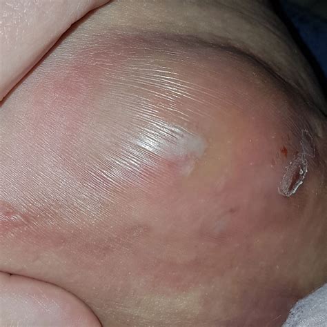 Ingrown Pubic Hair Boil