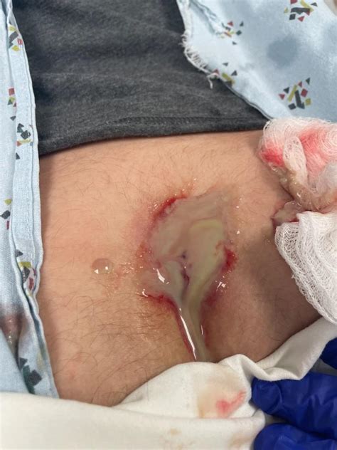 Infected Pilonidal Abscess