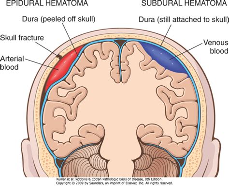 Nursing Care Plan Epidural Hematoma Post Craniotomy Mapametawan