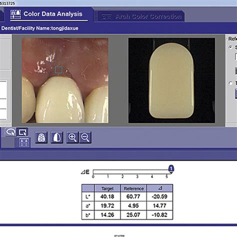 Thickness Of Peri Implant Soft Tissue Mean ±standard Deviation Download Scientific Diagram