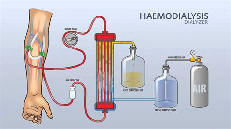 HAEMODIALYSIS DIALYZER - YouTube