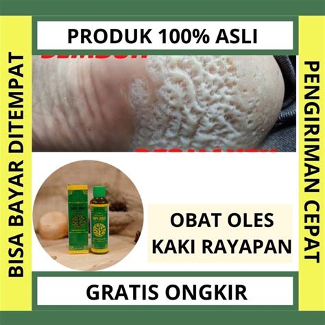 Obat Kaki Rayapan Minyak Oles Jamur Kaki Gatal Sela Jari Tinea