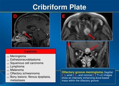 Ppt Ee 137 Mr Imaging Review Of The Skull Base Foramina And Their