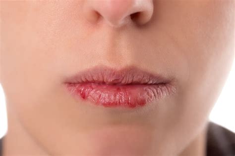 What Does It Mean if You Have a Black Spot on Your Lip? - Beauty Mag