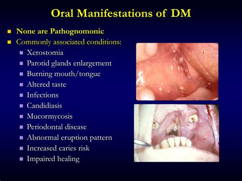 PPT Diabetes Mellitus For Dentist PowerPoint Presentation Free