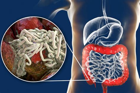 Penyakit Enterobiasis Gejala Penyebab Pengobatan Kompas