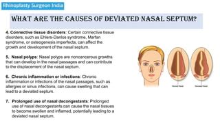 What Is Deviated Nasal Septum Pdf