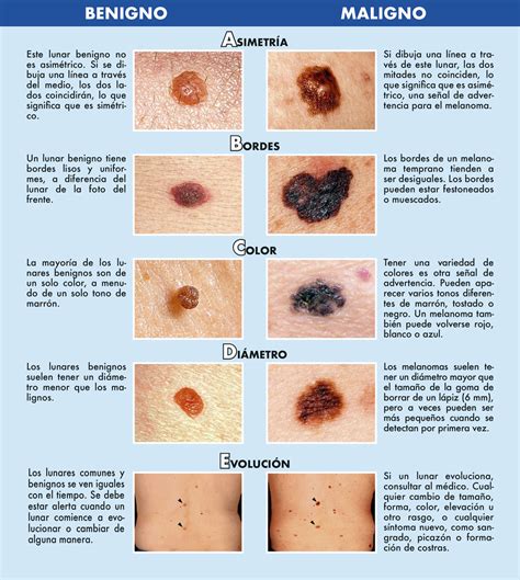 Detecci N De Melanomas El Abcde Leterago