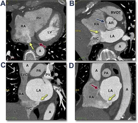 Imaging Of Adult Atrial Septal Defects With CT Angiography JACC