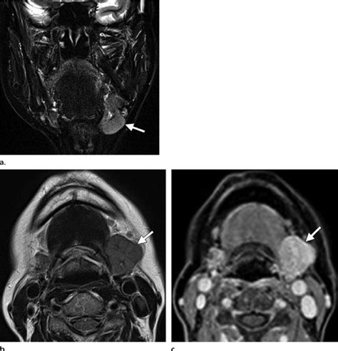 Küttner Tumor In A 76 Year Old Woman A Coronal Short Inversion Time