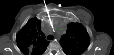 Mediastinum - CT Guided Biopsy