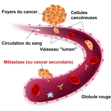 Cancer secondaire symptômes traitement quelle espérance de vie