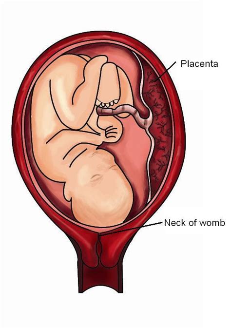 Placenta Accreta Pitter Patter