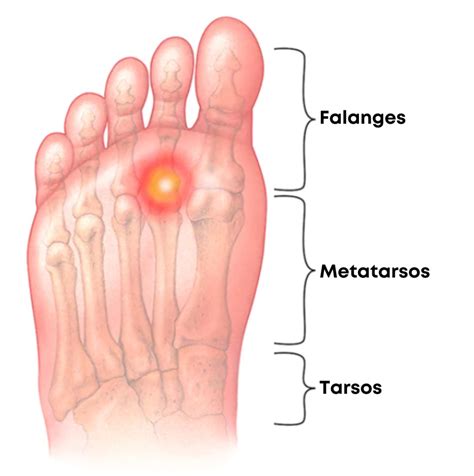 O Que É Metatarsalgia - Metatarsalgia: o que é, sintomas, causas e tratamento - Clínica Corts