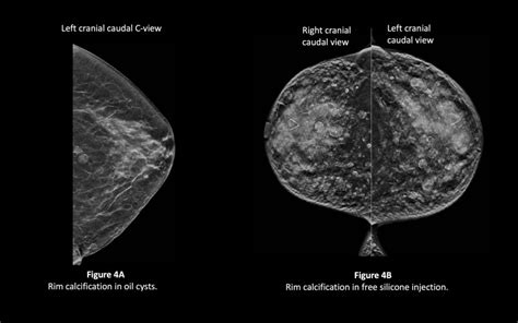 Benign Breast Calcifications StatPearls NCBI Bookshelf