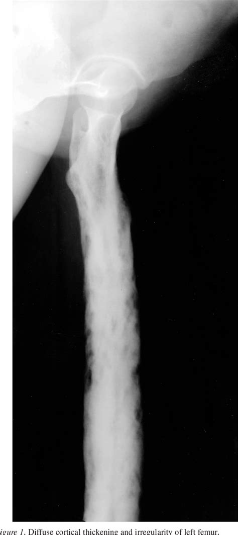 Figure 1 From Chronic Diffuse Sclerosing Osteomyelitis Treated With Risedronate Semantic Scholar