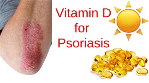 Role Of Vitamin D In Psoriasis Healing YouTube