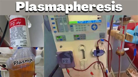 Plasmapheresis and its procedure explained in nepali/ - YouTube