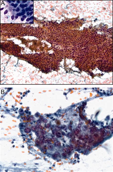 Diagnostic Accuracy And Limitations Of Fine‐needle Aspiration Cytology Of Bone And Soft Tissue