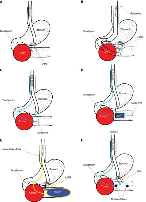 Endoscopic Ultrasound Guided Gastrojejunostomy For Gastric Outlet