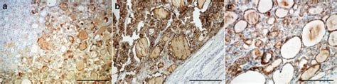 Immunolabelling Of The WDT UMP Lesion For Galectin 3 2a HBME 1 2b