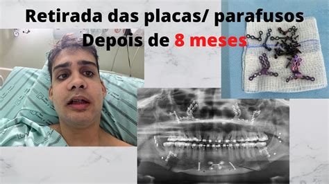 Cirurgia Ortognática Retirada das placas Pré e Pós operatório