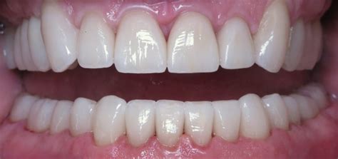 Before And After Dental Treatment Modern Dental Care