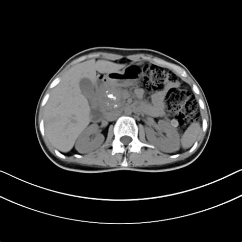 Intralobar Sequestration Image Radiopaedia Org