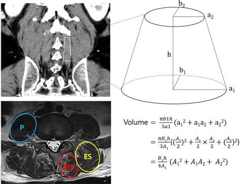 Measurements Of Paraspinal Muscles Mf Multifidus Es Erector Spinae Download Scientific