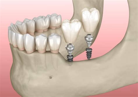 Bone Grafting For Dental Implants Cost Types And Process