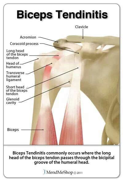 Biceps Tendinitisi Gues I Have Diagnosed My Self Bicep