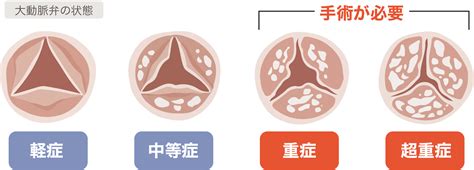 大動脈弁狭窄症の新しい治療法「tavi」｜社会医療法人蘇西厚生会 松波総合病院