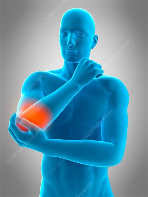 Human Elbow Pain Illustration Stock Image F0168243 Science