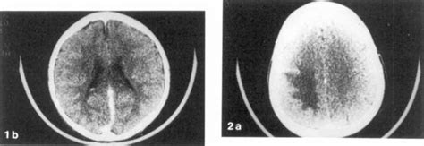 Fig La Patient 1 Enhanced Scan 48 After Last Seizure Diffuse Gyral