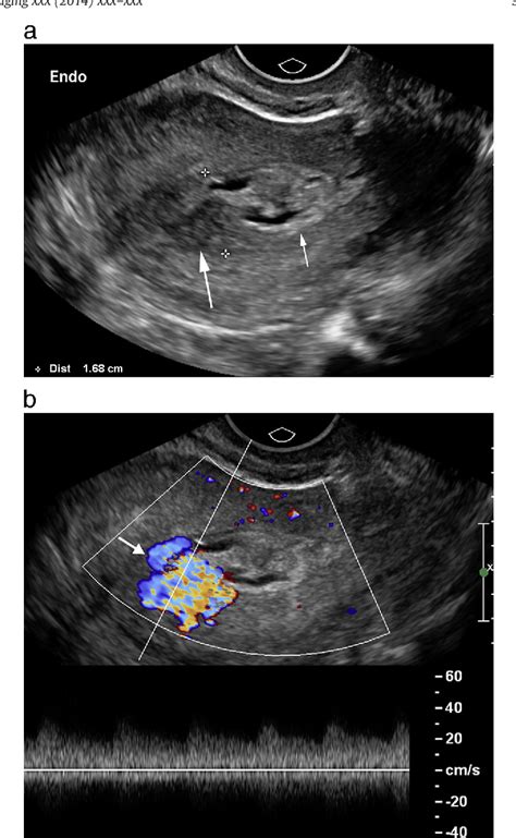 Figure 1 From Pearls And Pitfalls In First Trimester Obstetric Sonography Semantic Scholar