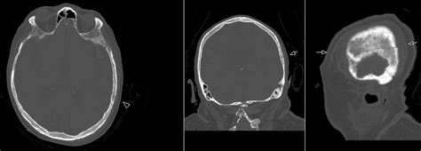 Horizontal Parietal Fracture