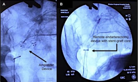 Remote Endarterectomy To Remove Infected Viabahn Stent Graft Journal