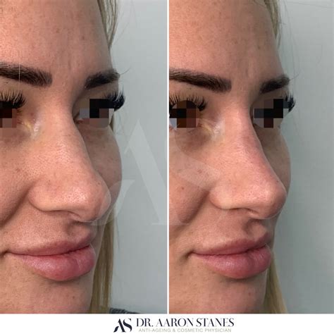 Non Surgical Rhinoplasty Purpose To Hide Bumps Straighten Your Nose