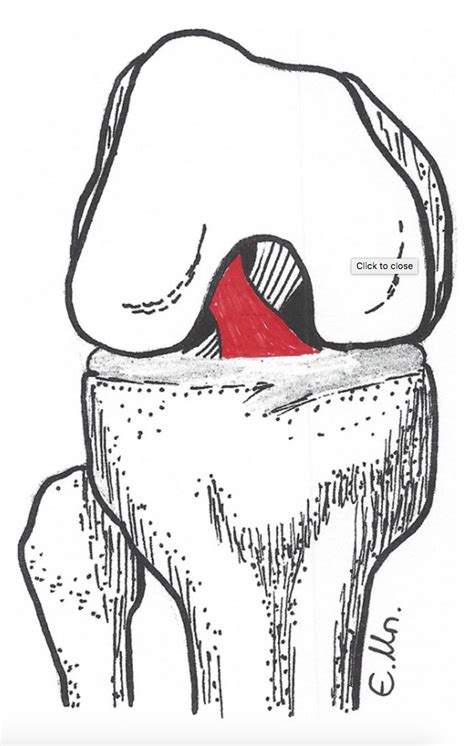 Anterior Cruciate Ligament Acl — Amir Qureshi Orthopaedic Surgeon