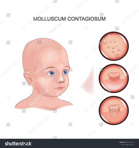 Vector Illustration Molluscum Contagiosum Child Stock Vector Royalty