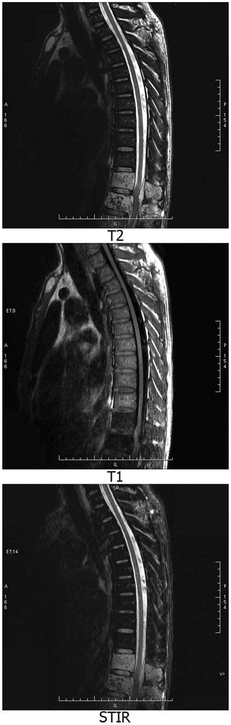 Thoracic Vertebrae Magnetic Resonance Imaging Mri Scan Showing Download Scientific Diagram