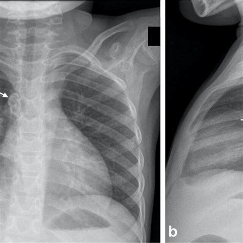 Anteroposterior A And Lateral B Chest Radiographs In A