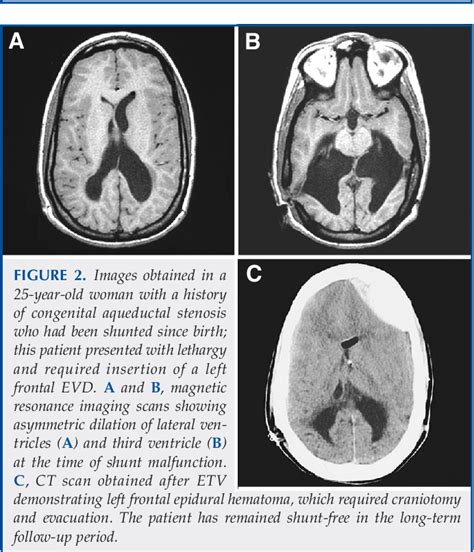 Complications Of Endoscopic Third Ventriculostomy In Previously Shunted Patients Semantic Scholar