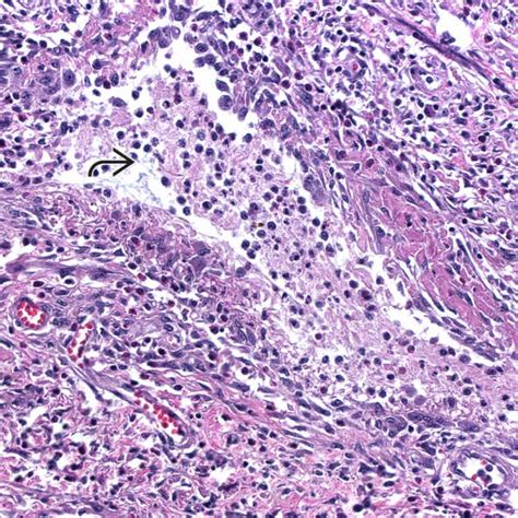 Groove Pancreatitis | Basicmedical Key